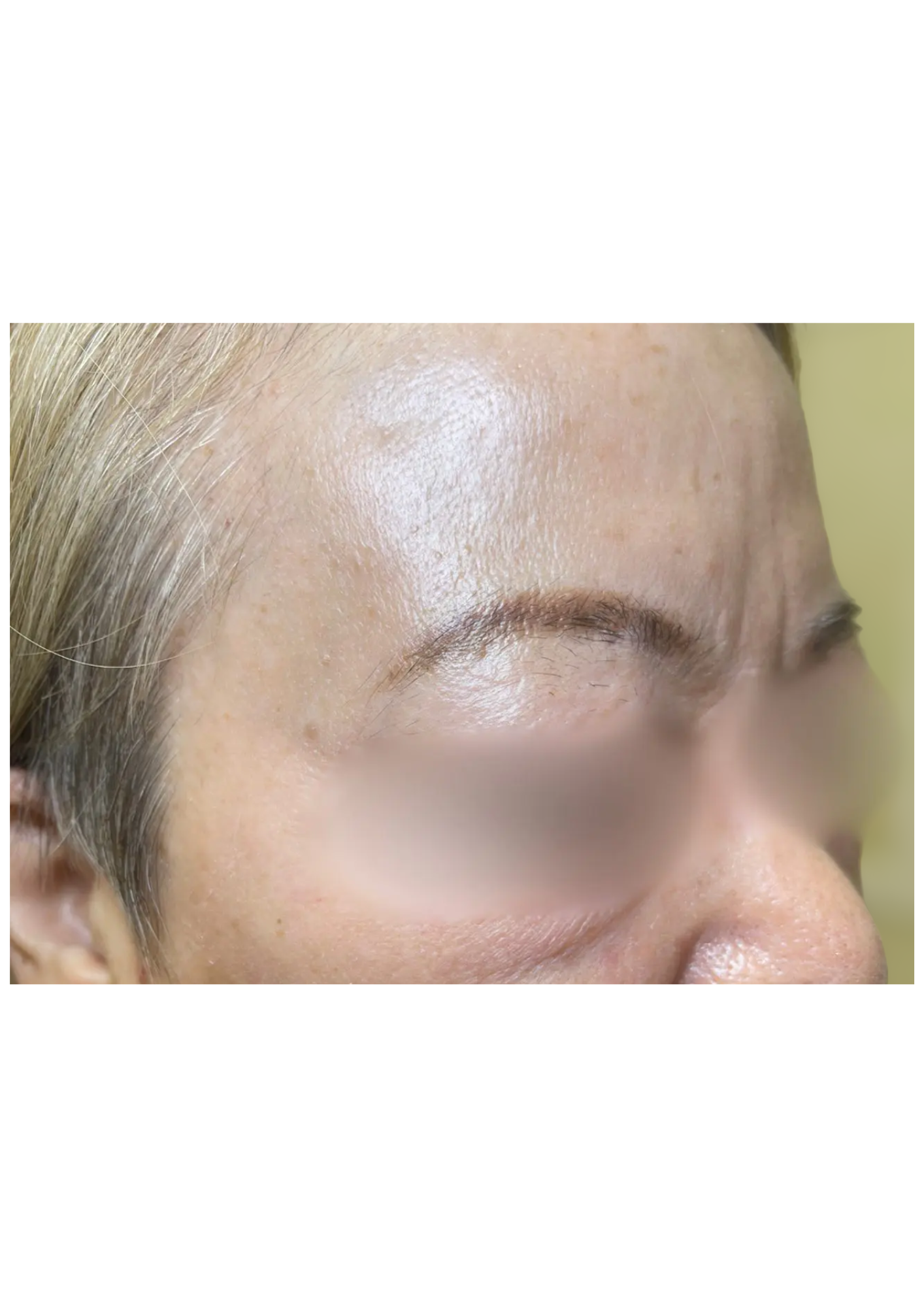 牧田医院・ピコスポット取り放題＋ガウディスキンセラピューティック①・after・右側