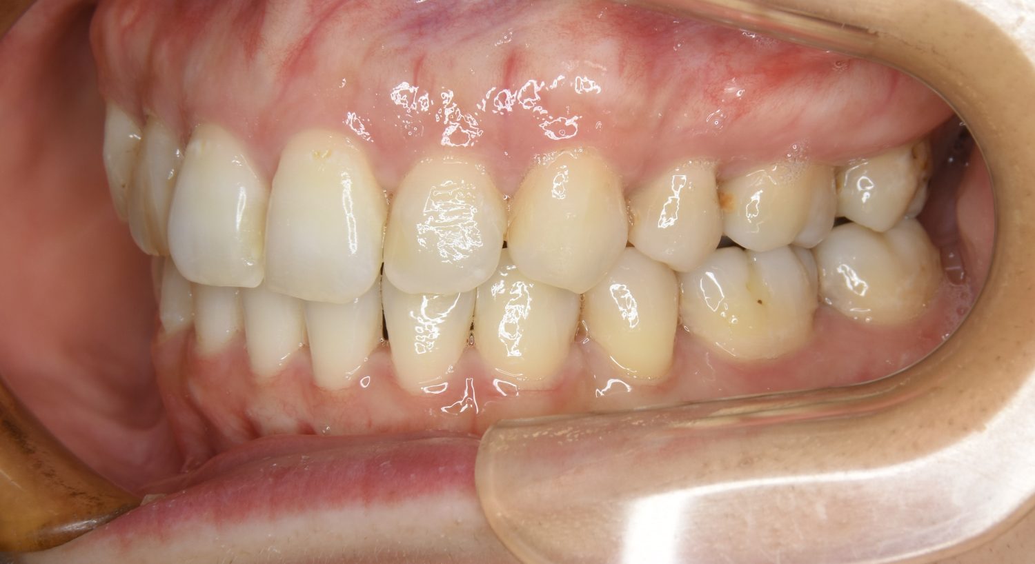 ピーススマイル矯正歯科 上下顎前突② after 左側