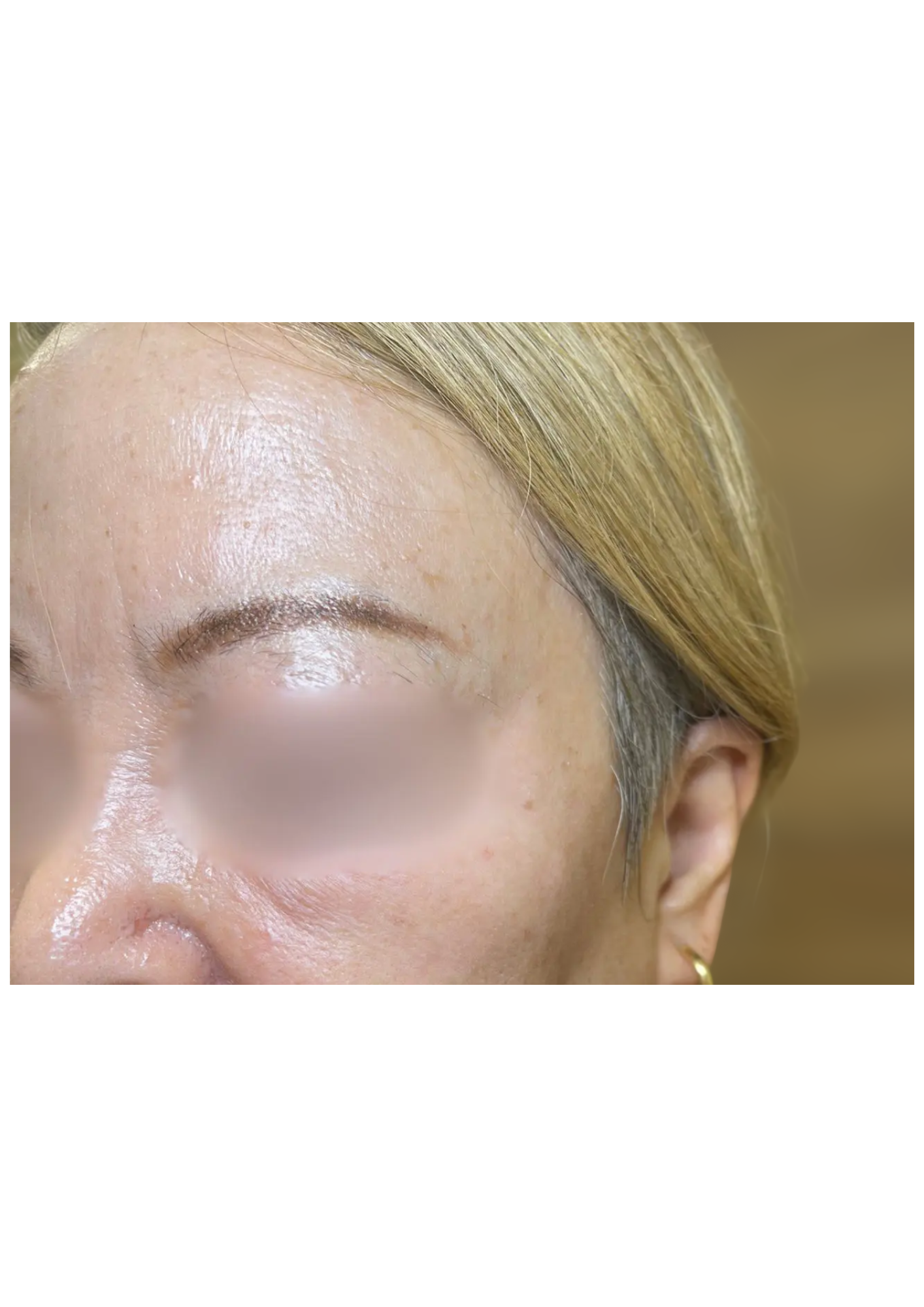 牧田医院・ピコスポット取り放題＋ガウディスキンセラピューティック①・after・左側