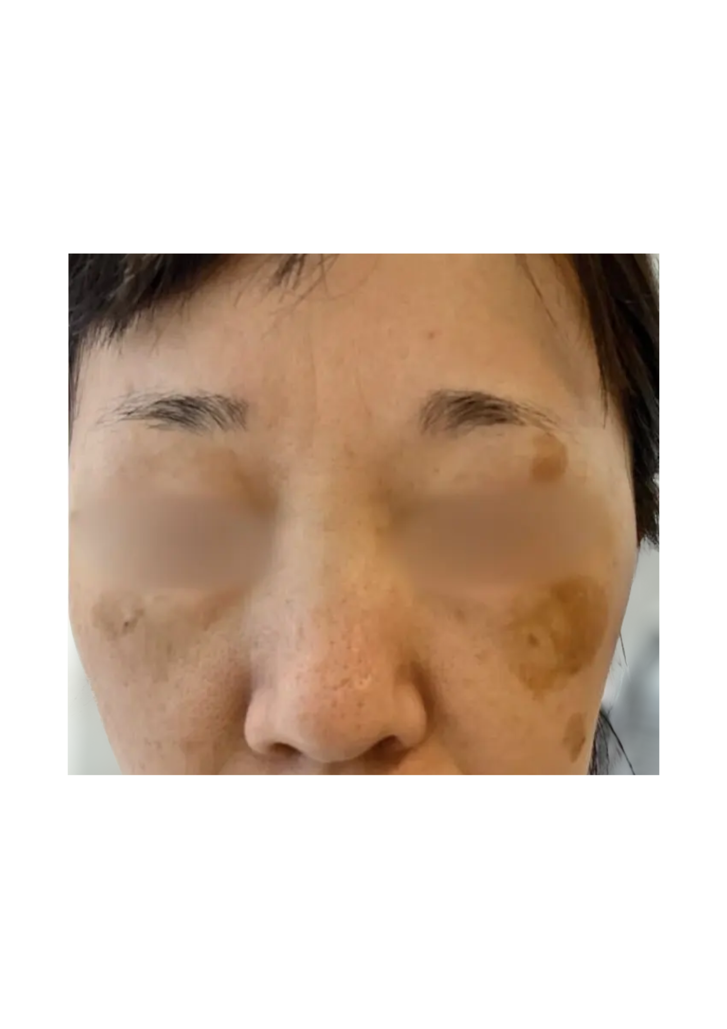 牧田医院・ピコスポット取り放題＋ガウディスキンセラピューティック②・before・正面