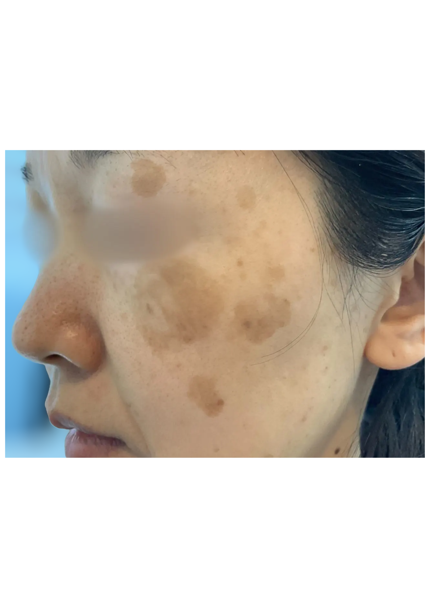 牧田医院・ピコスポット取り放題＋ガウディスキンセラピューティック②・before・左側