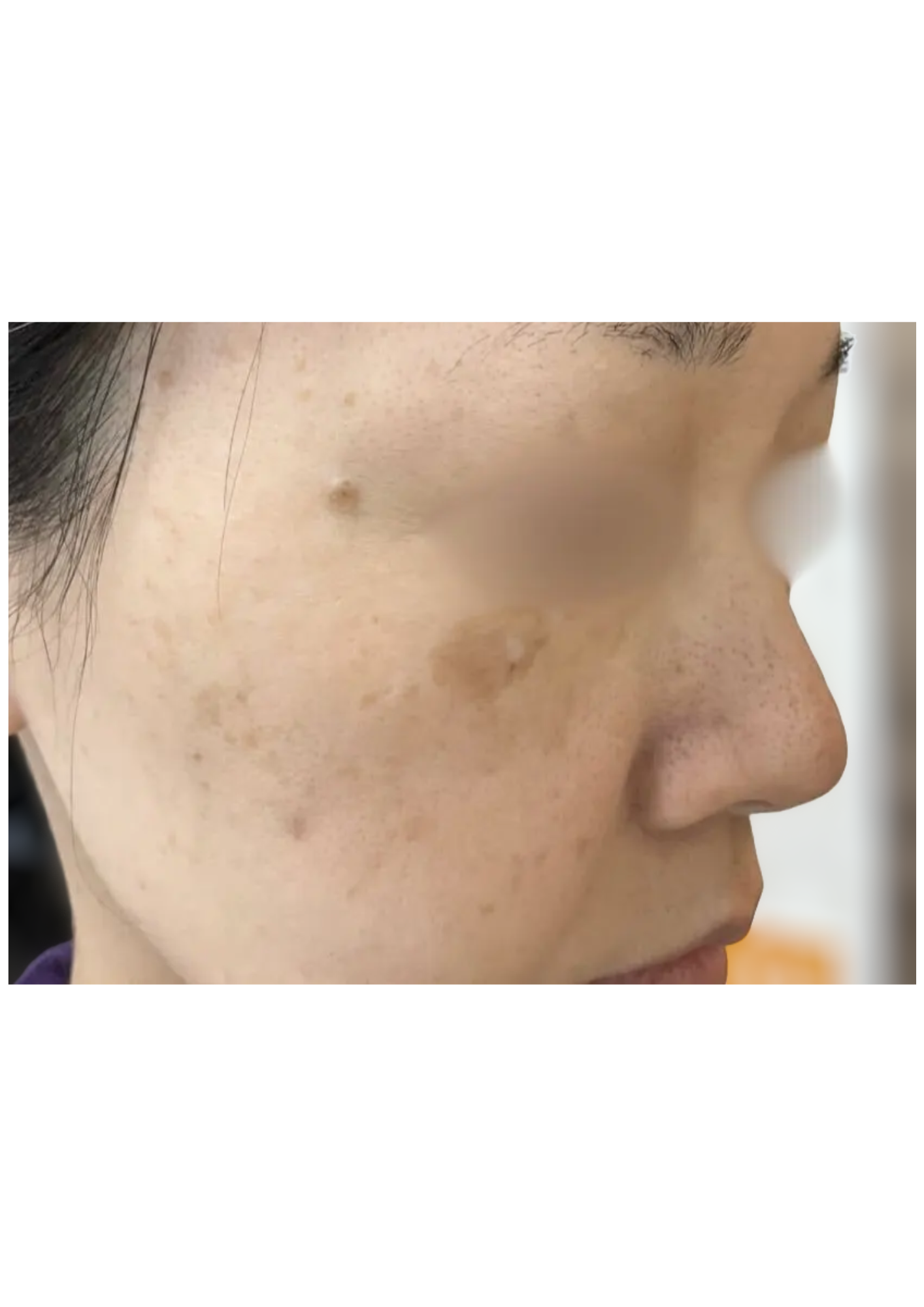 牧田医院・ピコスポット取り放題＋ガウディスキンセラピューティック②・before・右側