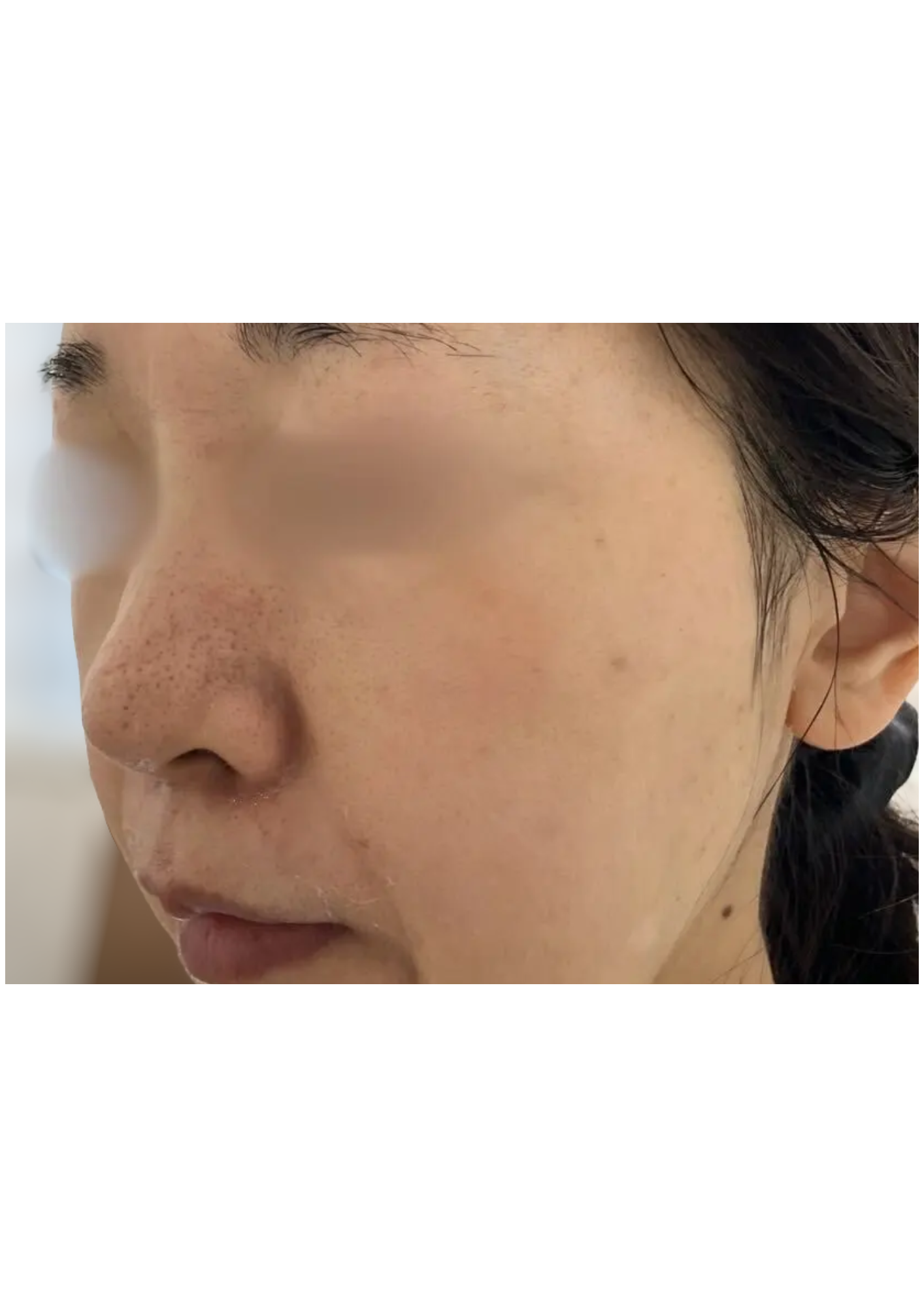 牧田医院・ピコスポット取り放題＋ガウディスキンセラピューティック②・after・左側