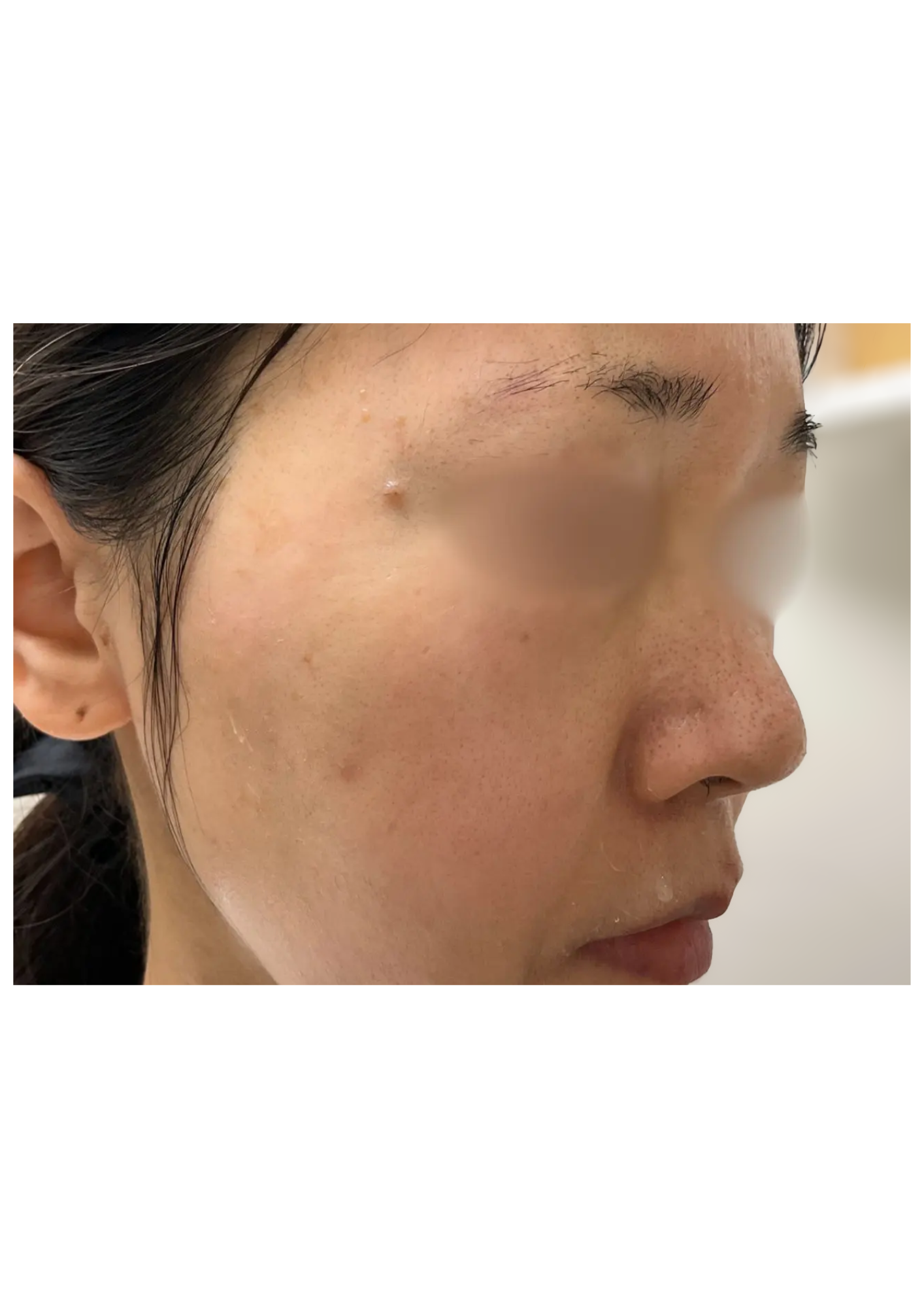 牧田医院・ピコスポット取り放題＋ガウディスキンセラピューティック②・after・右側