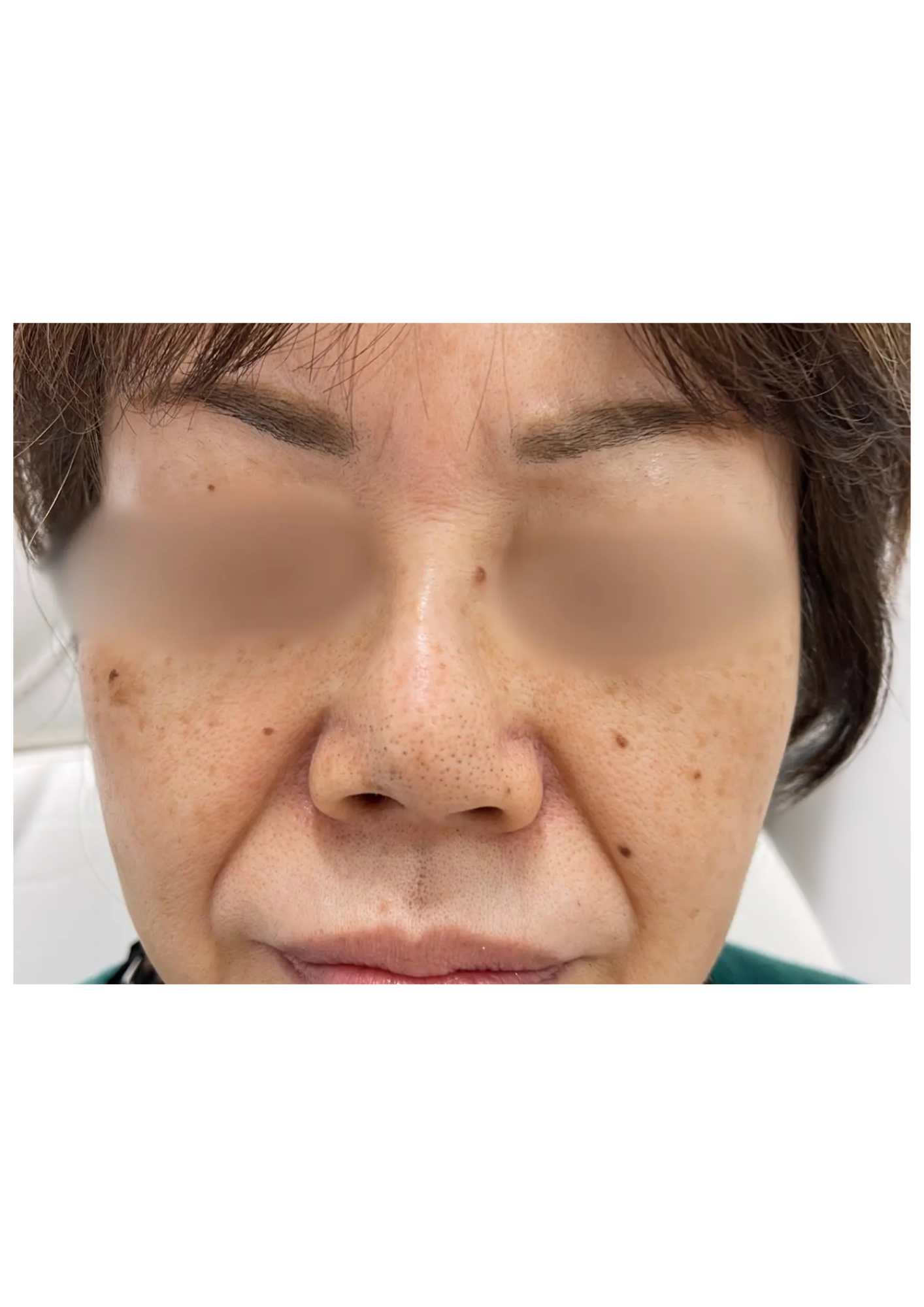 牧田医院・ピコスポット＋トーニング・before・正面