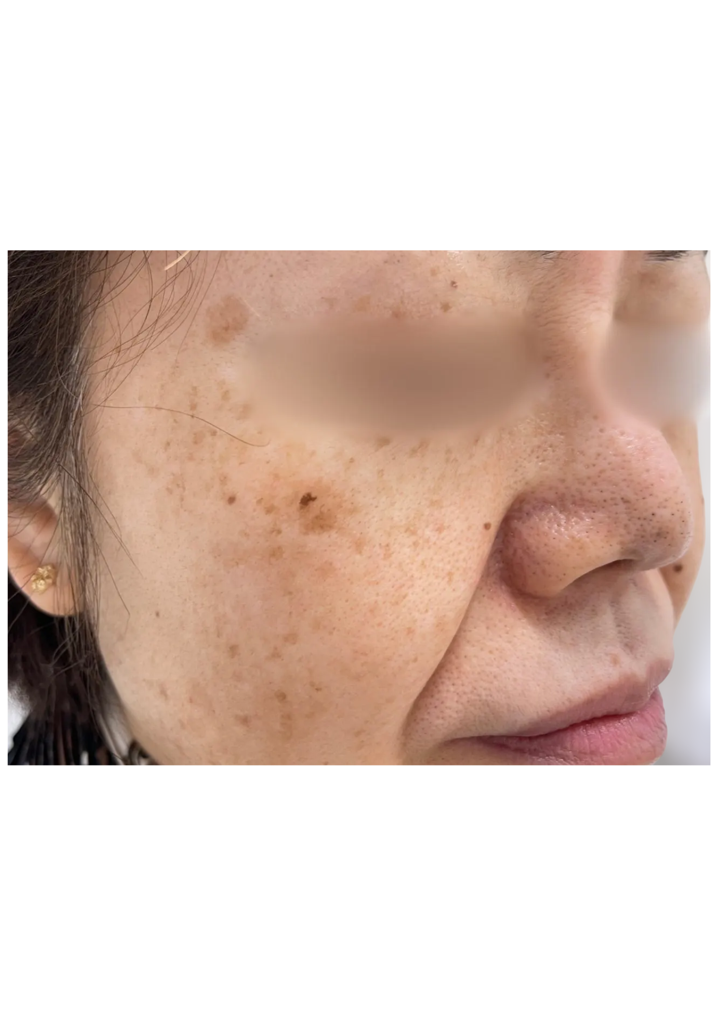 牧田医院・ピコスポット＋トーニング・before・右側