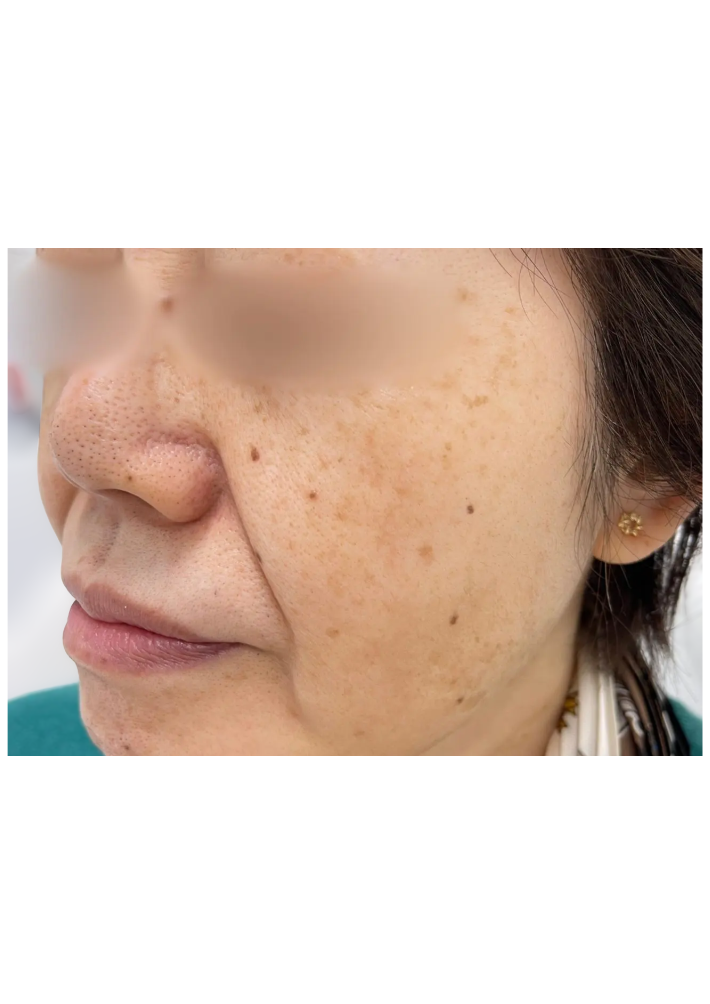 牧田医院・ピコスポット＋トーニング・before・左側