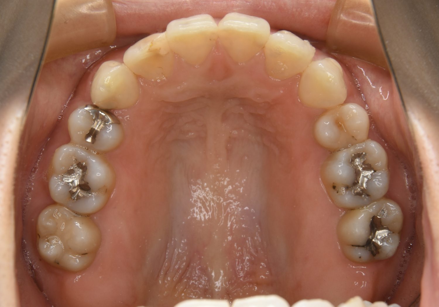 ピーススマイル矯正歯科 上下顎前突② after 上側