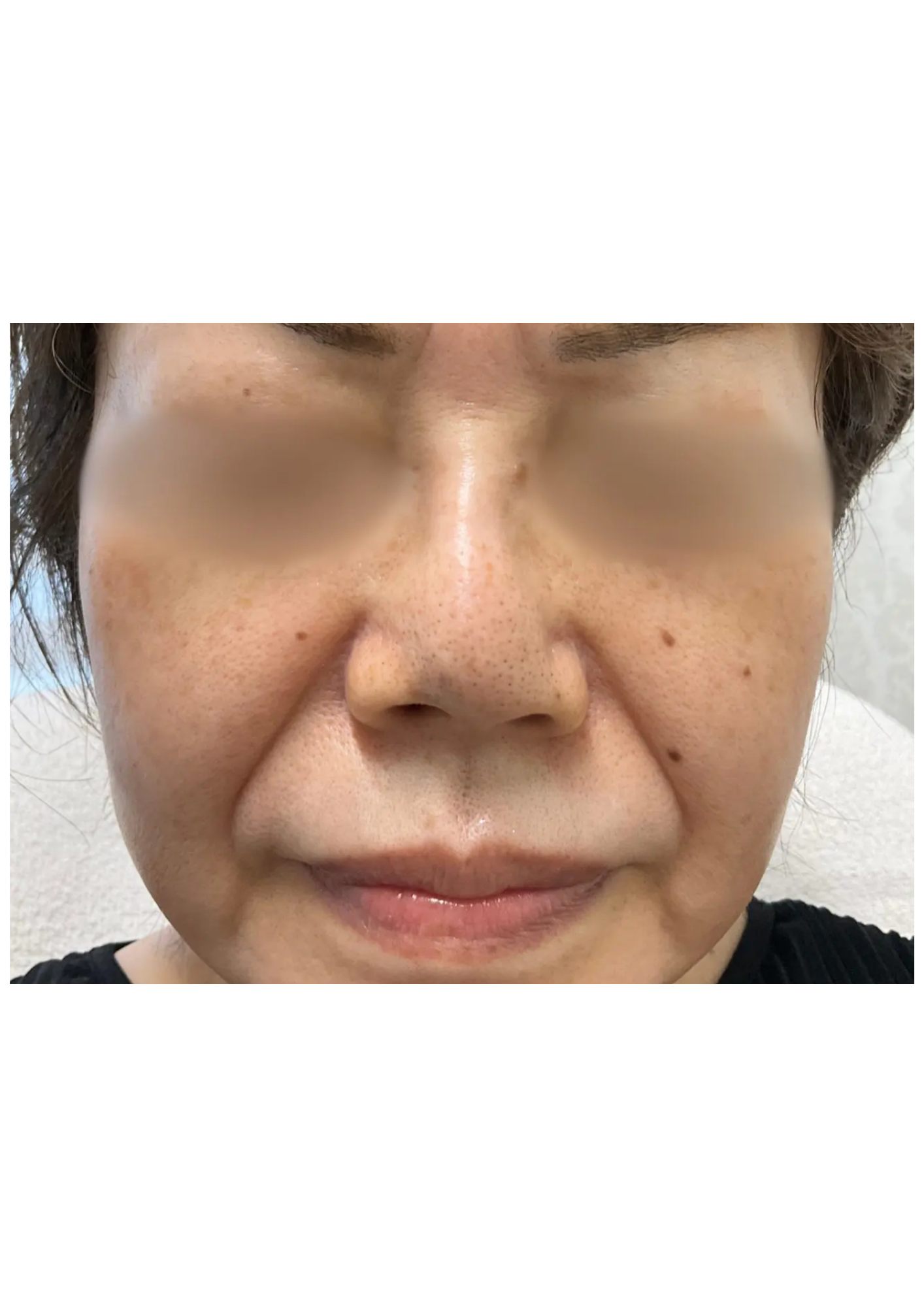 牧田医院・ピコスポット＋トーニング・after・正面