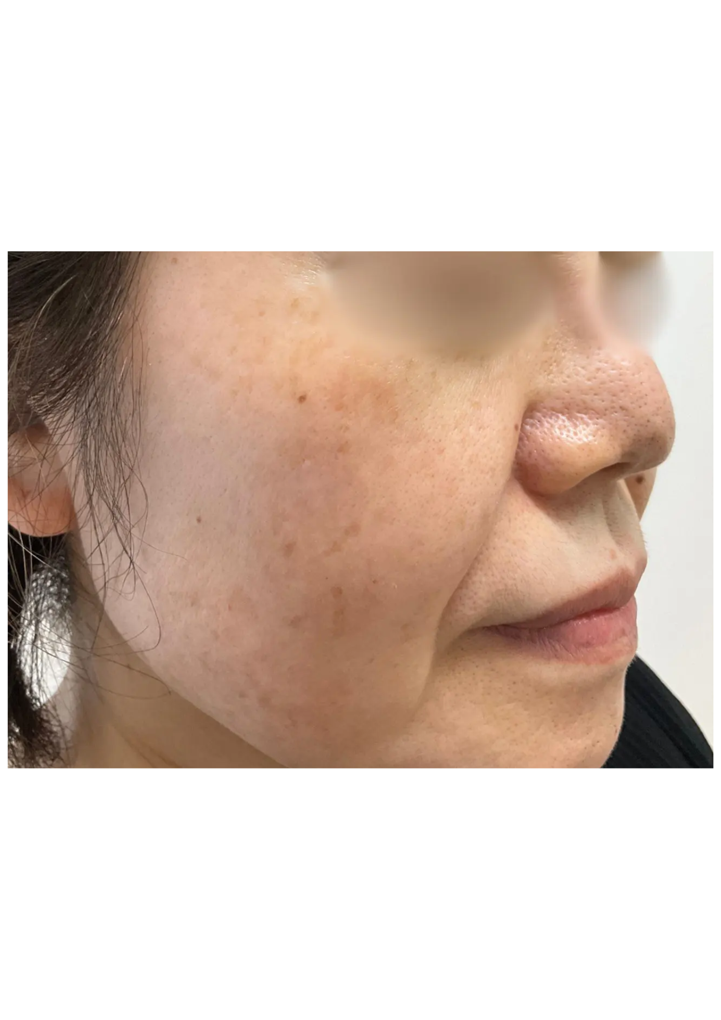 牧田医院・ピコスポット＋トーニング・after・右側