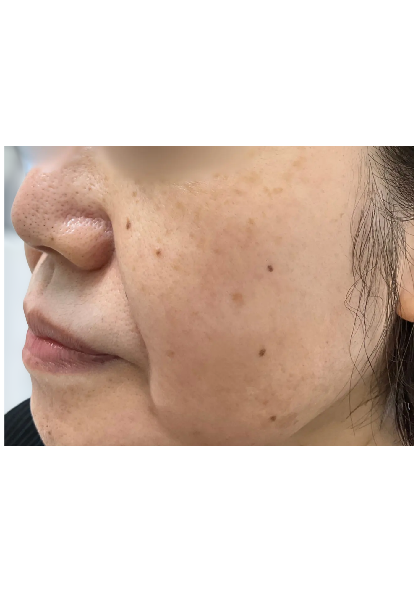 牧田医院・ピコスポット＋トーニング・after・左側