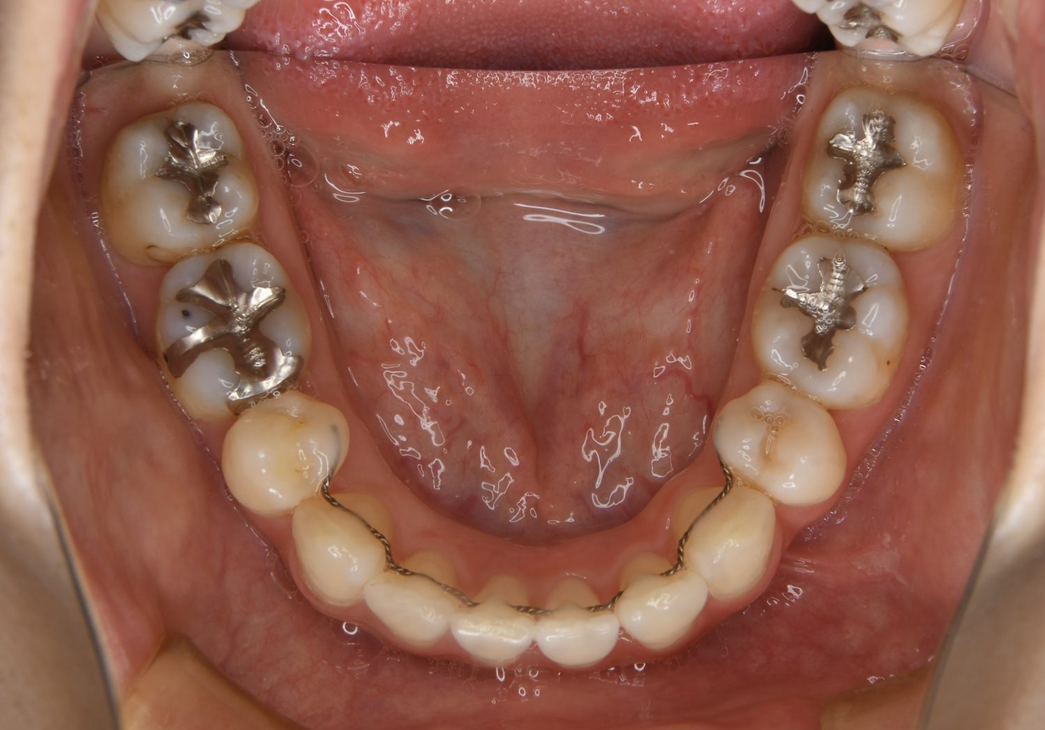 ピーススマイル矯正歯科 上下顎前突② after 下側