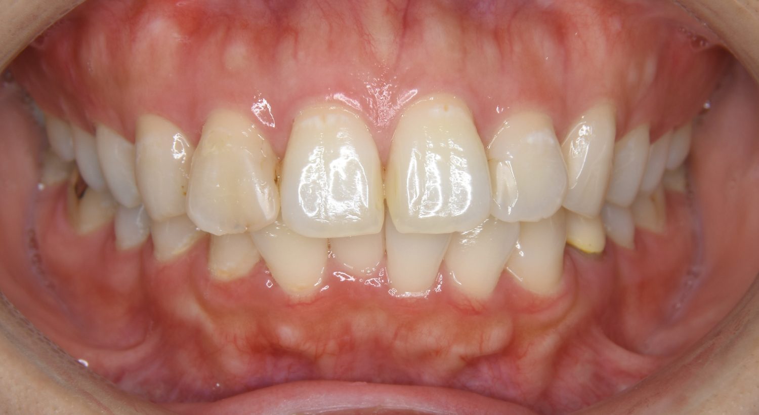 ピーススマイル矯正歯科 上下顎前突③ before