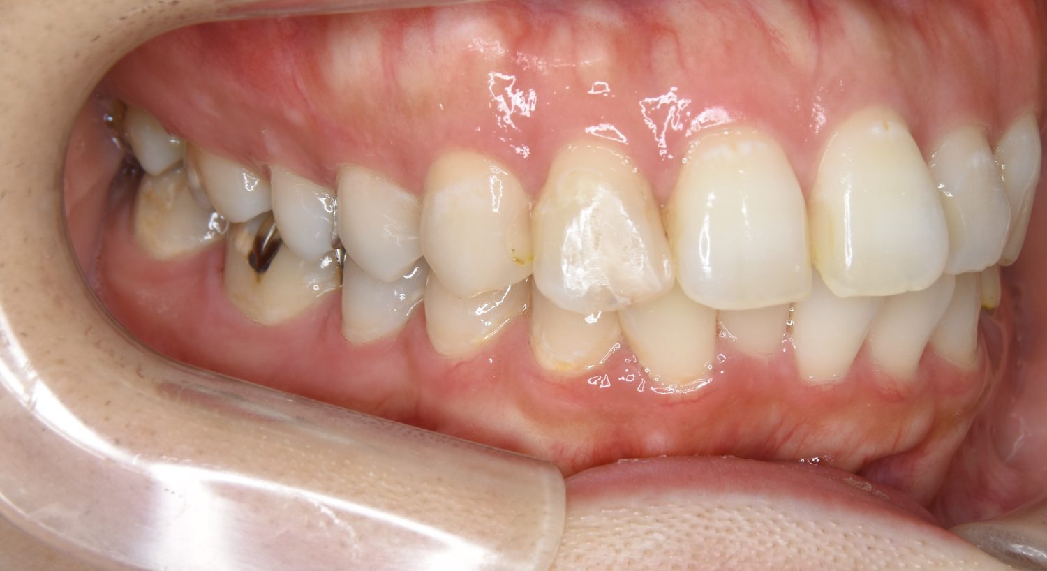 ピーススマイル矯正歯科 上下顎前突② before 右側