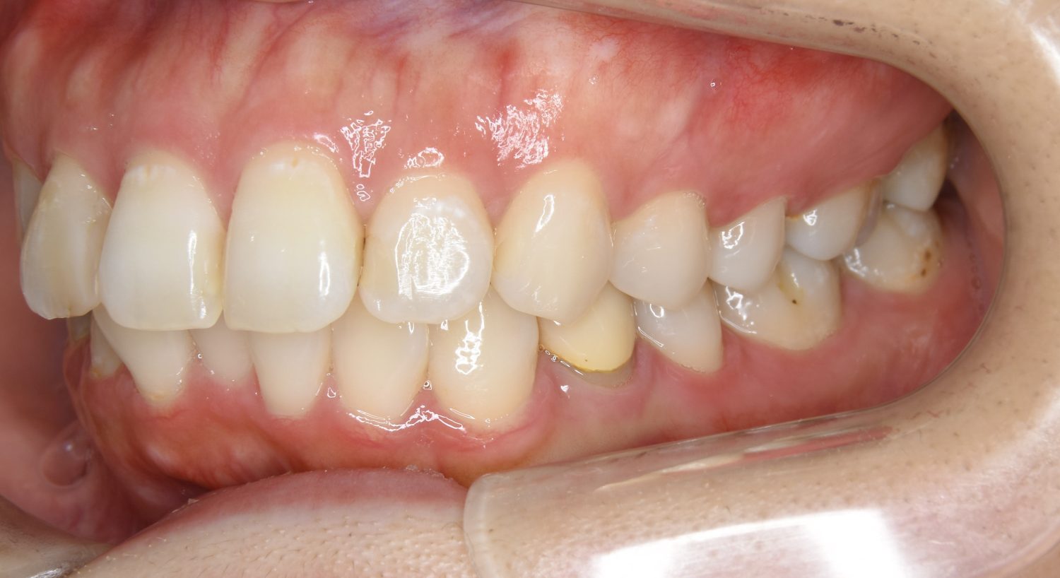 ピーススマイル矯正歯科 上下顎前突② before 左側