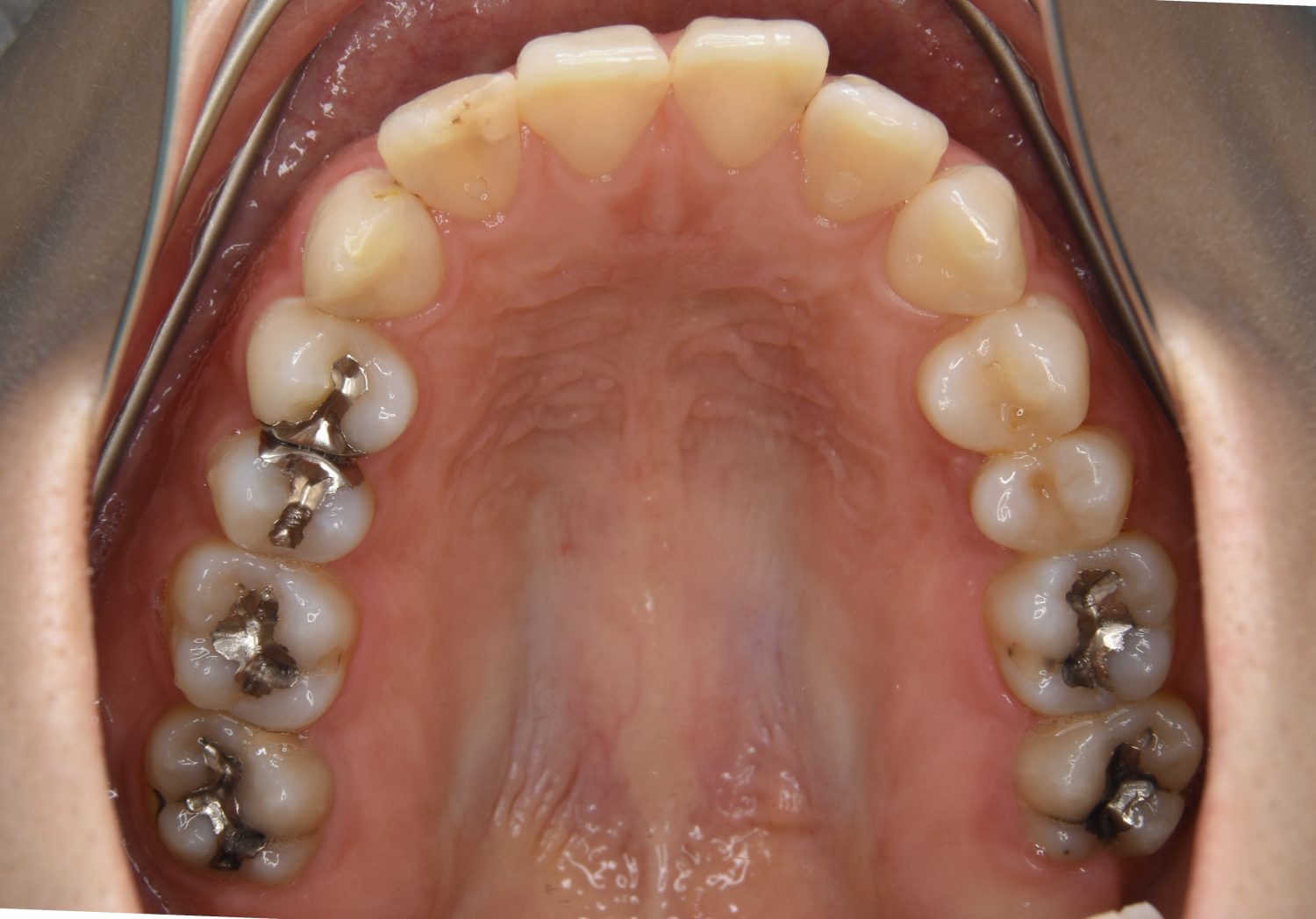 ピーススマイル矯正歯科 上下顎前突② before 上側