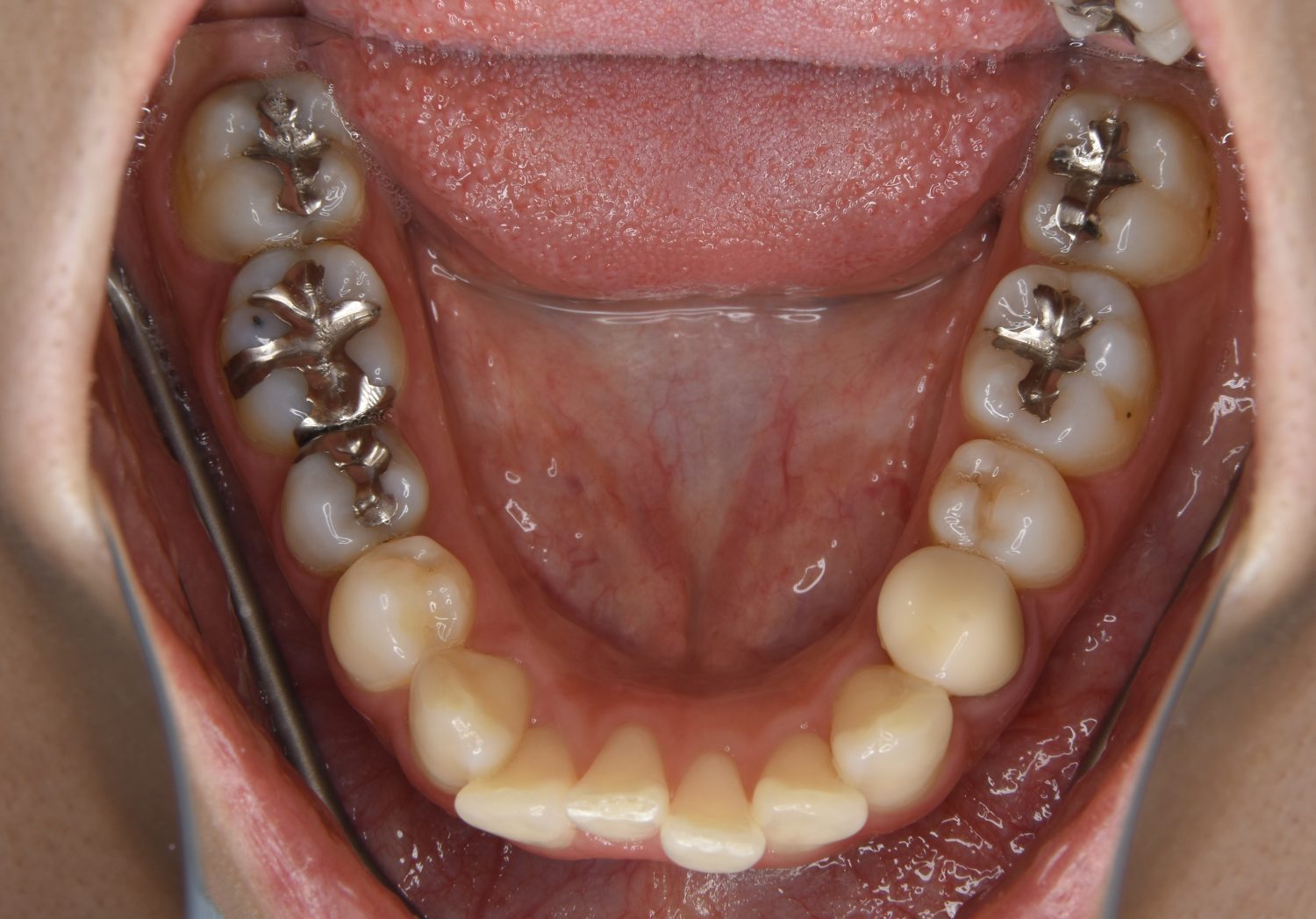 ピーススマイル矯正歯科 上下顎前突② before 下側