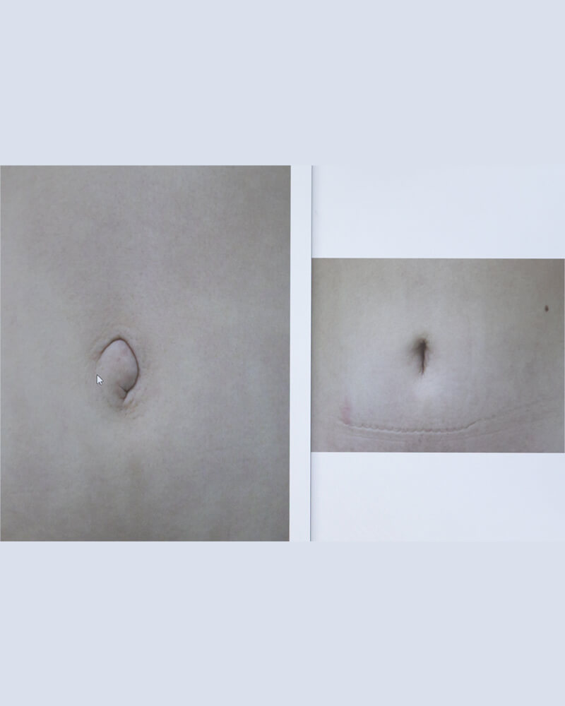 手術で叶える「自然な縦長のおへそ」