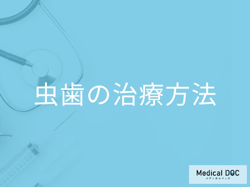 「むし歯の治療法」はご存じですか？軽度から抜歯まで歯科医師が解説！
