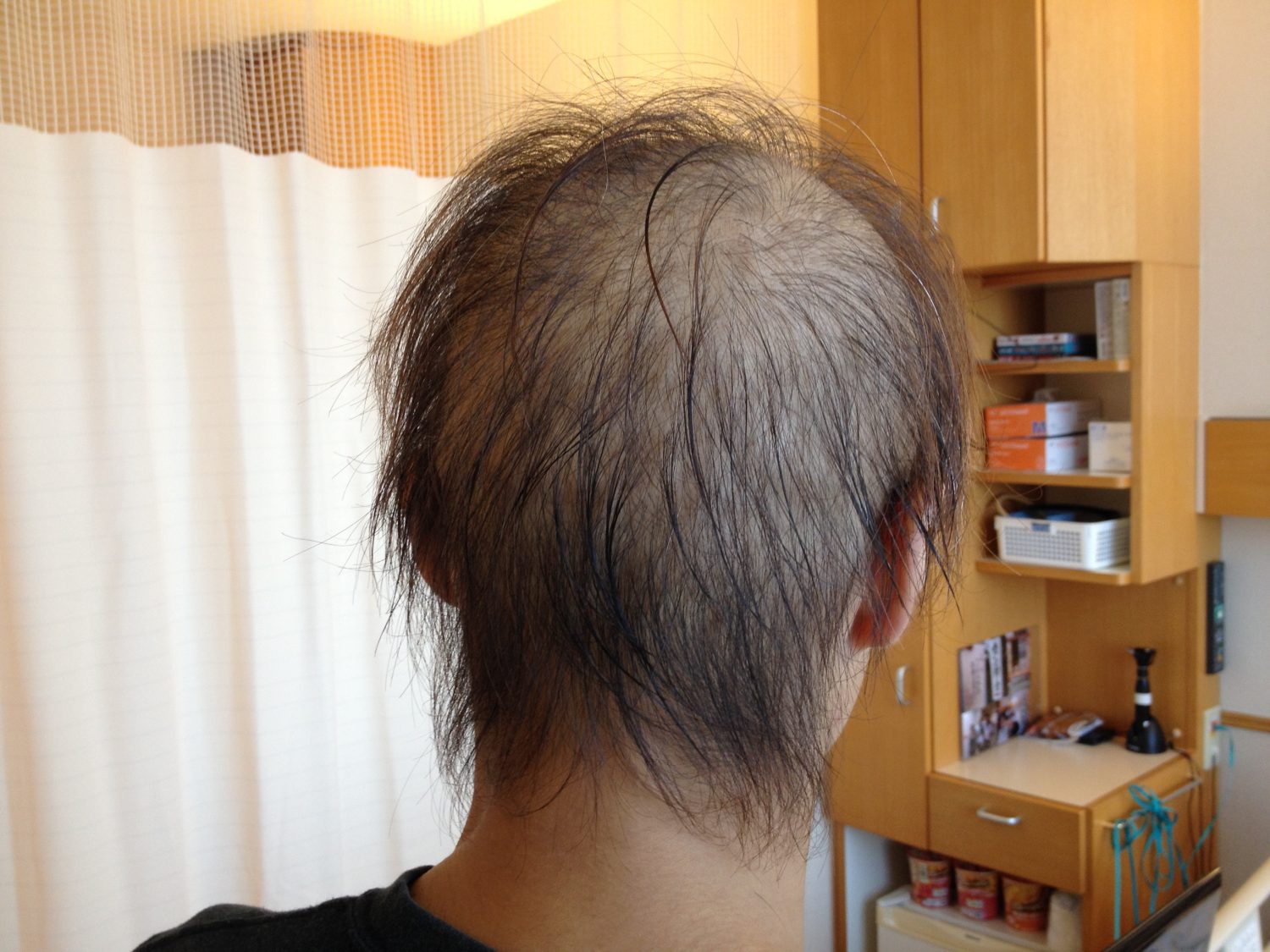 抗がん剤の副作用に打ち勝つ気持ち「こんなところで死ねない」