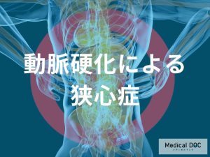 動脈硬化による狭心症の発症機序