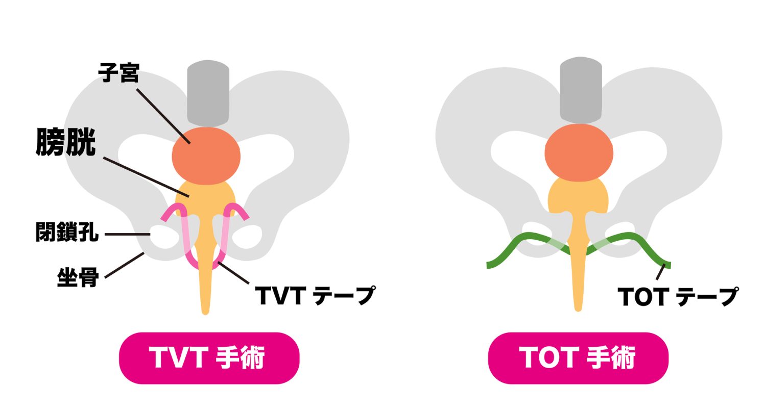 中部尿道スリング手術