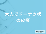 「大人でドーナツ状の皮疹」 ができる原因はご存じですか？考えられる病気も解説！