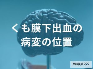くも膜下出血の出血源となる病変の位置