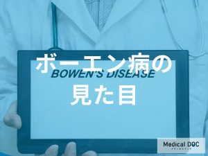 「ボーエン病を発症すると皮膚がどのように変化」するのか？医師が解説！