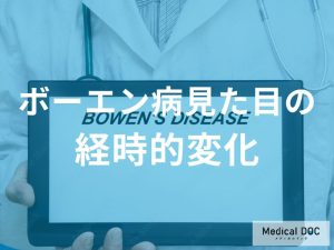 「ボーエン病が進行する」と皮膚はどのように変化するのか？医師が監修！