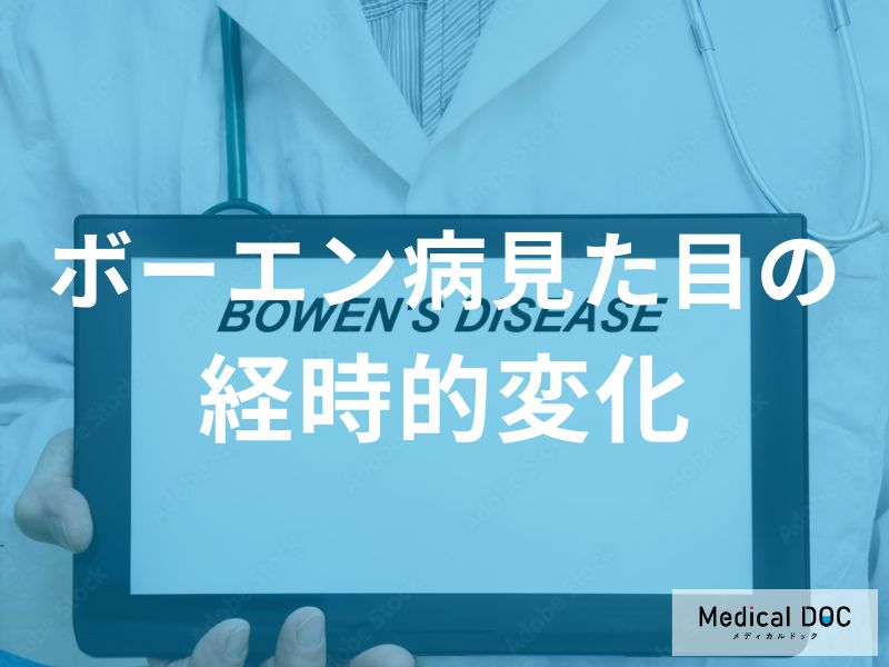 「ボーエン病が進行する」と皮膚はどのように変化するのか？医師が監修！