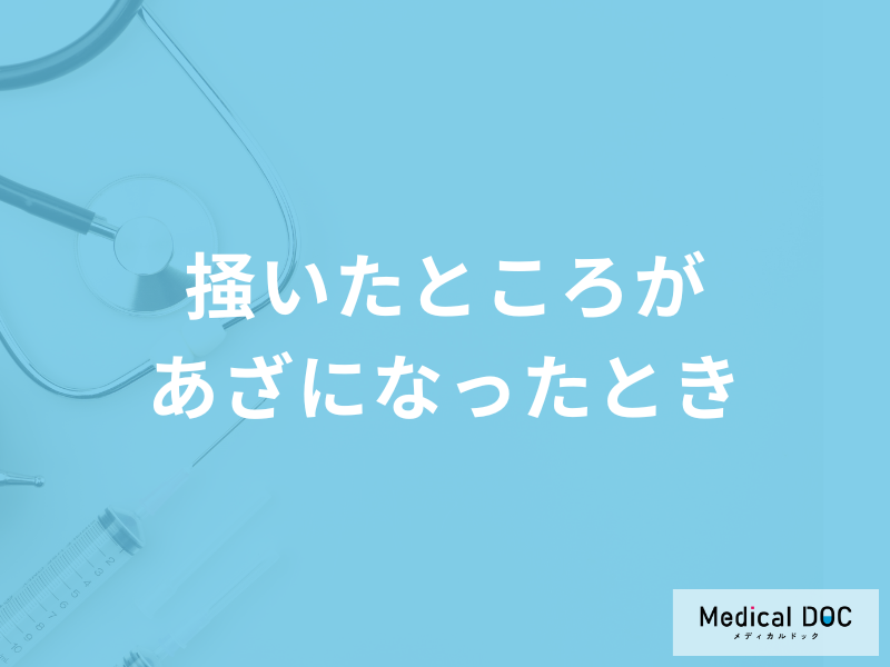 「掻いたところがあざになったとき」の治し方は?考えられる病気も医師が解説!