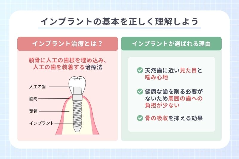 インプラントの基本を正しく理解しよう