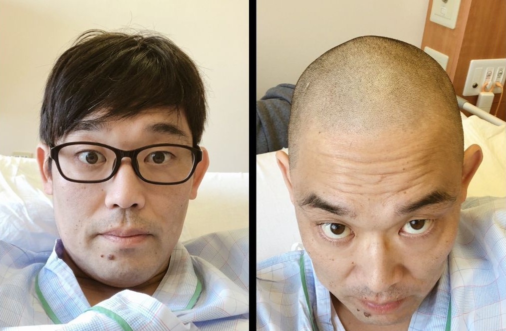 抗がん剤開始前散髪