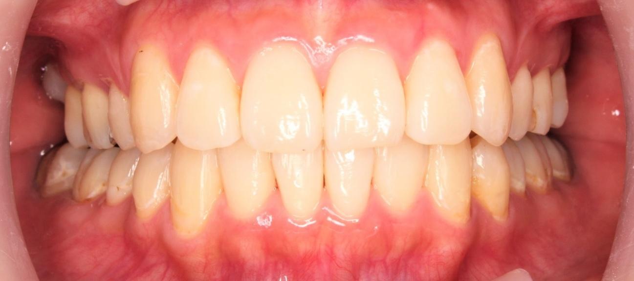 青山アール矯正歯科 難波院-症例2-術後1