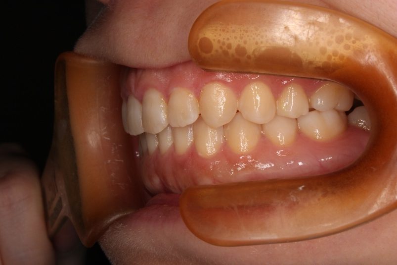 青山アール矯正歯科 難波院-症例5-術後2