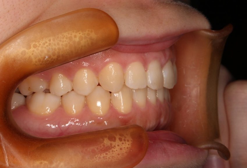 青山アール矯正歯科 難波院-症例5-術後3