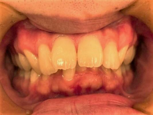 青山アール矯正歯科 難波院-症例1-術前1