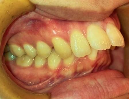 青山アール矯正歯科 難波院-症例1-術前3