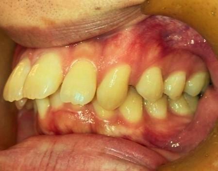 青山アール矯正歯科 難波院-症例1-術前2