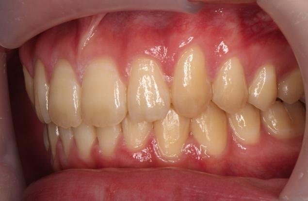 青山アール矯正歯科 難波院-症例1-術後2