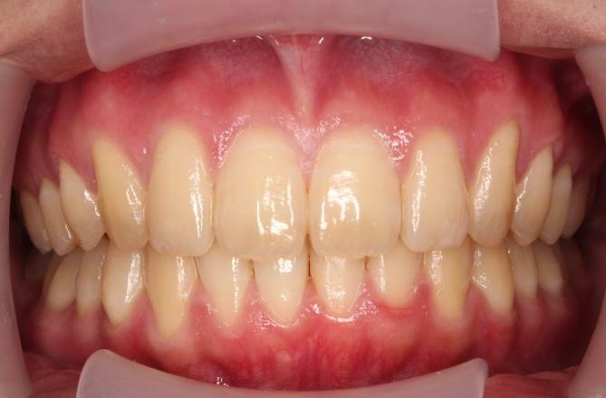 青山アール矯正歯科 難波院-症例1-術後1