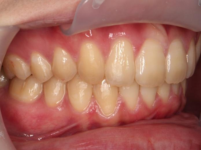 青山アール矯正歯科 難波院-症例1-術後3
