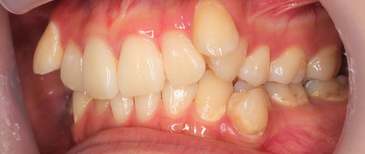 青山アール矯正歯科 難波院-症例2-術前3