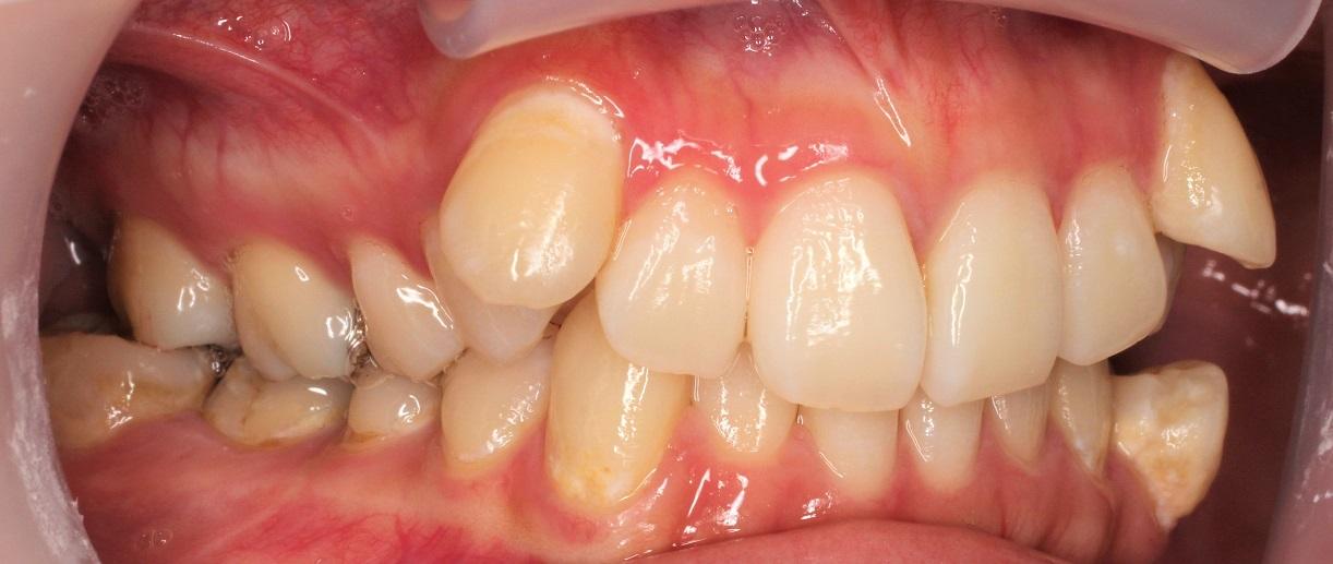 青山アール矯正歯科 難波院-症例2-術前2