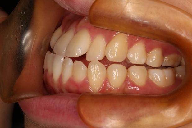 青山アール矯正歯科 難波院-症例4-術前3