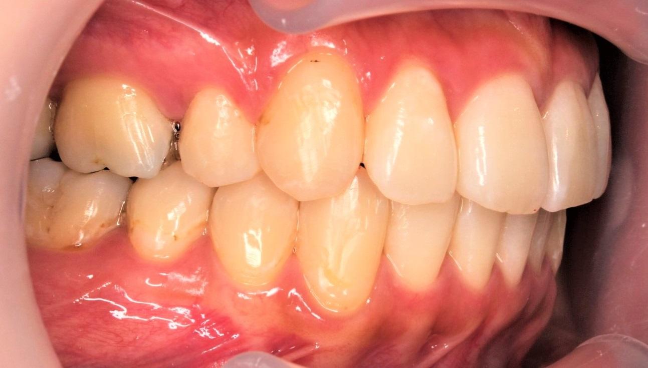 青山アール矯正歯科 難波院-症例2-術後2