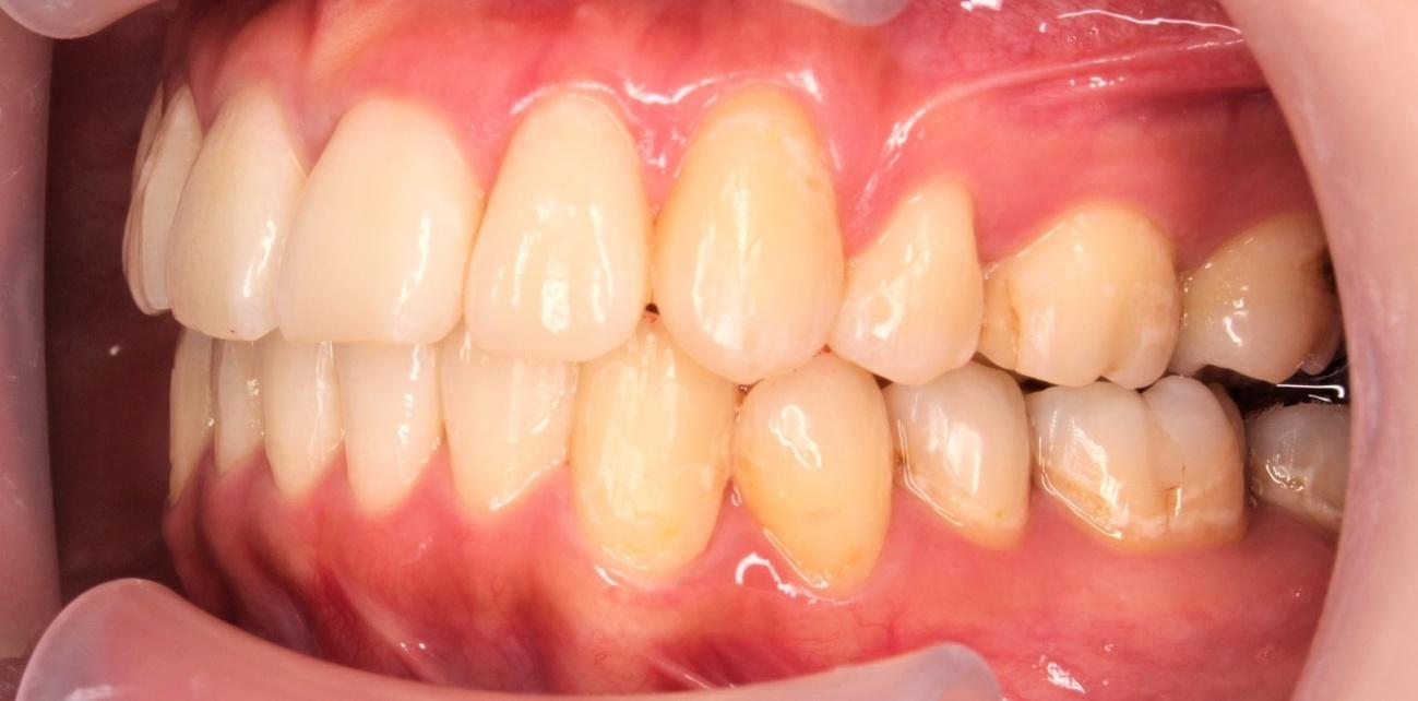 青山アール矯正歯科 難波院-症例2-術後3