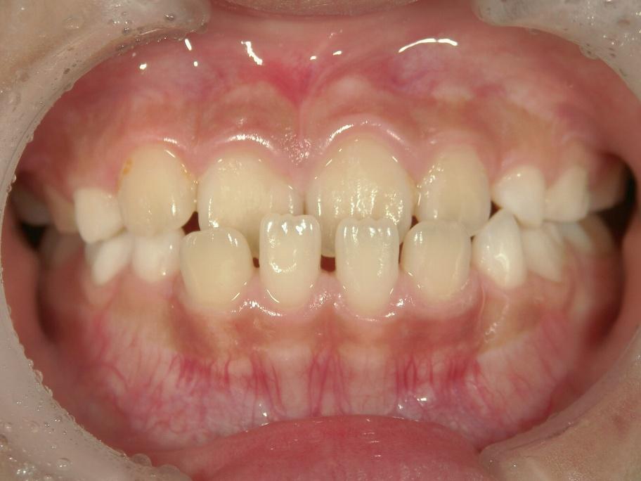 青山アール矯正歯科 難波院-症例3-術前1