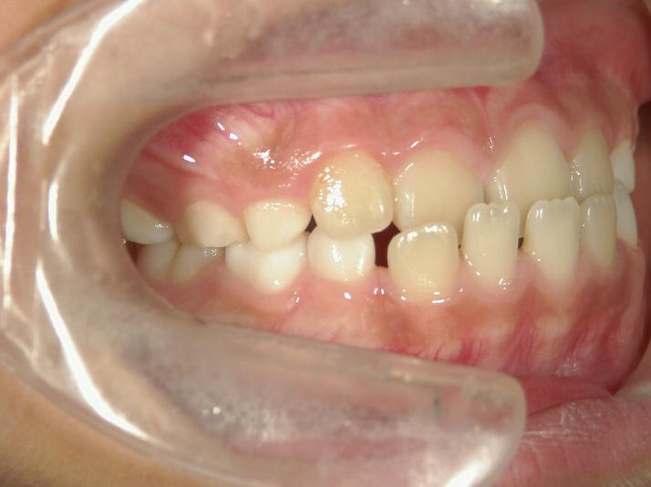 青山アール矯正歯科 難波院-症例3-術前2